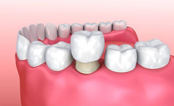 dental crown in jaw | dental crown white hills