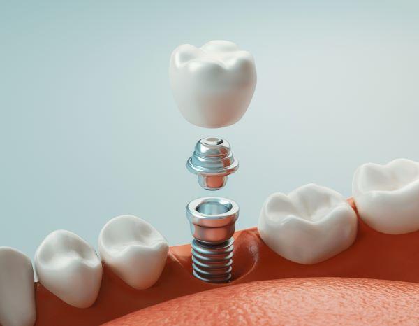 dental implant going into jaw | dental implants white hills