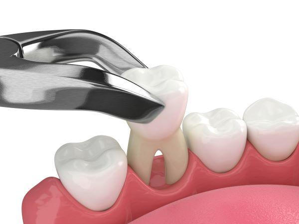 tooth being extracted | emergency dentist bendigo